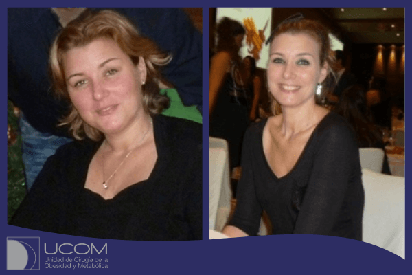 Antes y después de la reducción de estomago de Mireia