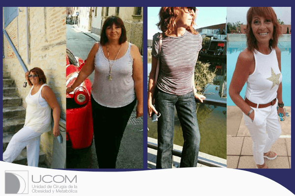antes y después de la reducción de estómago de Carmen
