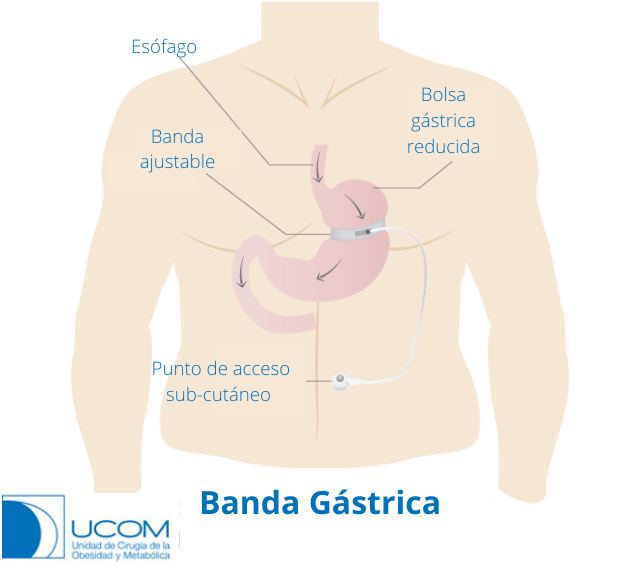 Banda gástrica aplicada en el intestino grueso