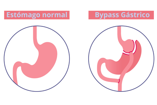 Antes y después de un bypass gástrico en un estómago